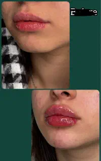 فیلر و ژل لب ، صورت و بدن ، دکتر اسدی صفا