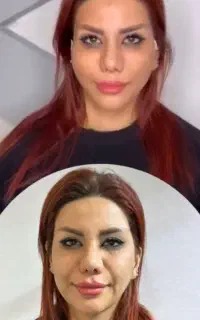 جشنواره لیفت صورت با نخ ۳ساله با تضمین توسط پزشک