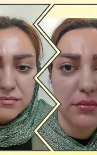 50%تخفیف شرایط اقتصادی لیزر و زیبایی درماپریس