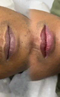 رفع تیرگی لب آقایان - اصلاح رنگ طبیعی لب