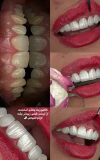 کامپوزیت تخصصی فقط از فکی ۳.۵ اقساطی