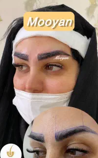 کاشت مو ۲۲ و کاشت ابرو ۱۵