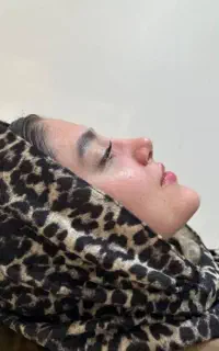 عمل بینی اقساطی فقط با ماهی ۳ تومن استخوانی وگوشتی