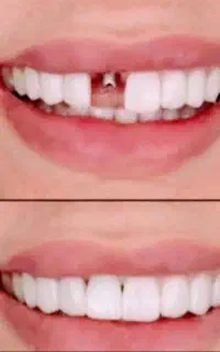 مرکز فوق تخصصی ایمپلنت دیجیتال مشهد سبک کاخ لبخند