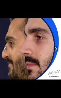 عمل بینی در تهران بدون بستری