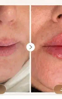 تخفیفات فیلر لب روسی، بادی،بوتاکس، مزوژل و لیفت نخ