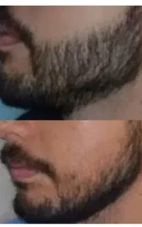 رویش طبیعی ریش در کمترین زمان