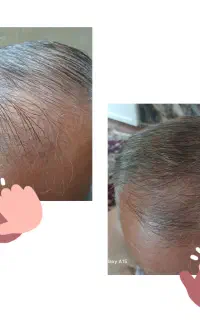 کاشت طبیعی مو/پری و پرپستی مو/معجزه رفع سفیدی مو
