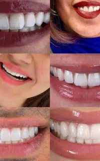 شرایط اقس*اط دندانپزشکی بدون بهره