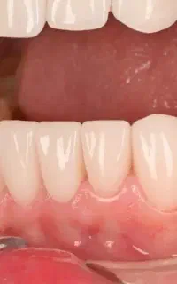 شرایط اقساطی ویژه ایمپلنت کره