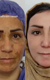 لیزرco2 فرکشنال جوانساز درمان لک‌ تک جلسه درکلینیک