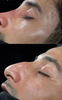 عمل زیبایی بینی و پلک/لیفت صورت با تعرفه ۱۴۰۴