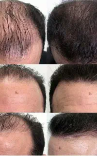 این اشتباه کوچیک ممکنه موهات دیگه خوب نشه