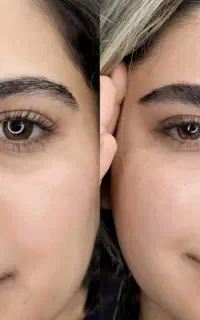 فیبروز و میکروبلیدینگ کرکی مویی برای ۱۰نفر ۱۳۰۰