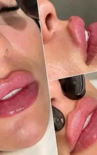 تزریق بوتاکس، فیلر و مزوتراپی توسط پزشک