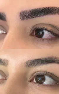 میکروبلیدینگ