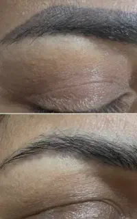 پاک کردن تتوبا تکنولوژی بایوتیک(بدون آسیب به پوست)