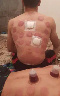 حجامت بادکش گرم کل تهران . ری