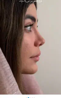عمل بینی با تخفیف ویژه،بدون تامپون