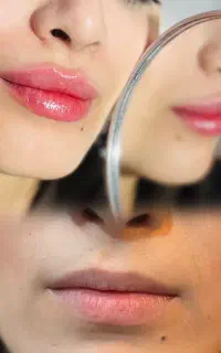 تزریق تخصصی لب -کانتور - بوتاکس - نخ