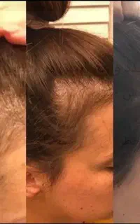 کاهش چربی سر و رویش دوباره