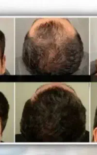موهات یطوری پرشت میشه که شونه لاش گیر میکنه