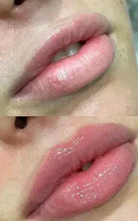تزریق  انواع فیلر صورت،لب ،از بین برنده غبعب