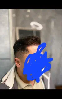 کاشت مو  با چک