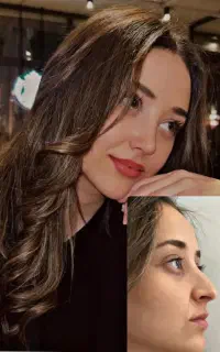فرصت استثنایی جراحی بینی(آفر ویژه)