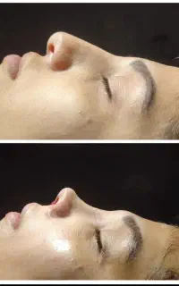 جراحی زیبایی بینی