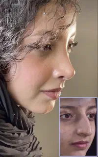 جراحی زیبایی قسطی بینی/ لیپو لیفت سینه مامو/بای پس