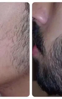 قطع ریزش مو و رویش مجدد مو و ریش