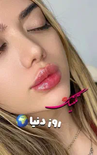 تزریق فیلر با جدید متد روز دنیا با بهترین قیمت