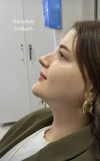 عمل جراحی بینی ۳۷