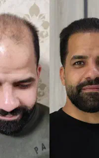 کاشت مو و ابرو تخصصی با نتیجه طبیعی در مولند