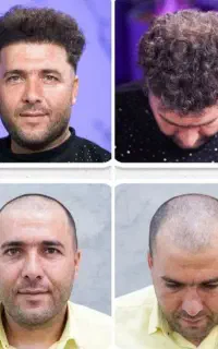 کاشت مو تضمینی با اقساط