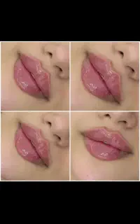 فیلر، ژل و بوتاکس