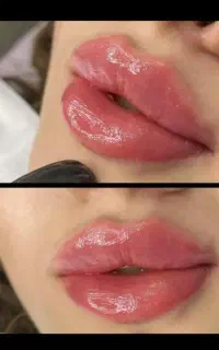 تزریق ژل وفیلر لب و گونه وچانه ومزو(جشنواره)درمطب