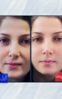 جشنواره کلینیک تزریق ژل لبMلیفت لیزر جوانساز آنزیم