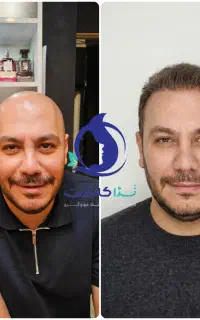 کاشت مو VIP در یک روز  با ضمانت تراکم
