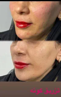 تزریق مزو prpژل و بوتاکس