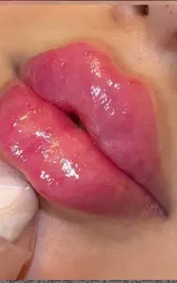 ژل،بوتاکس،فیلربادی باسن بیکینی،پی ارپی زاویه سازی