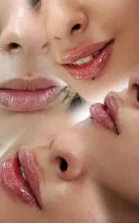 تزریق ژل فیلر بوتاکس مزوژل جوانساز مزوتراپی