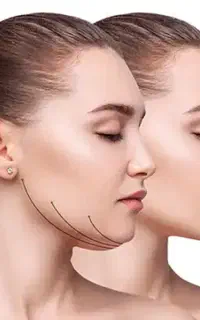 ساکشن‌‌غبغب‌‌و‌بلفاروپلاستی توسط‌پزشک‌در‌مرکزویشنو