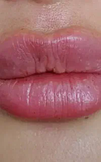 آموزش ژل ،بوتاکس ،چربی بصورت اقساطی