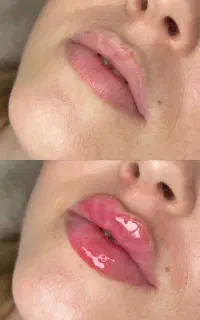 ژل و بوتاکس