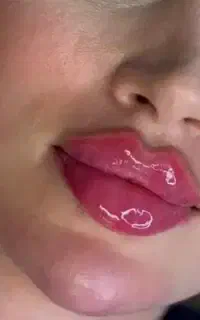 ژل بوتاکس آنزیم مزوچال لپ آموزش پرسینگ سوراخ گوش