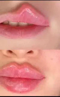 ژل‌ بوتاکس فیلر انزیم مزوژل اموزش پی ار پی فولفیس