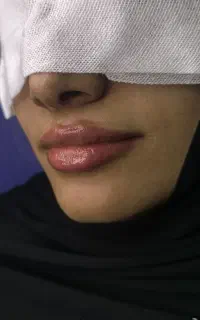 آف چربی بوتاکس ساکشن غبغب ژل مزو PRP، پزشک مجرب