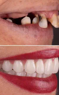 خدمات ویژه و منعطف ایمپلنت